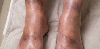 The silent signal: What your swollen legs may reveal about pancreatic cancer