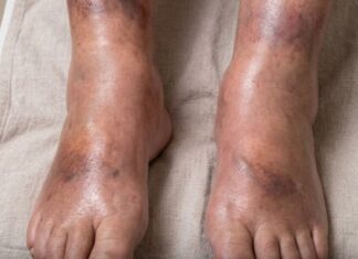The silent signal: What your swollen legs may reveal about pancreatic cancer