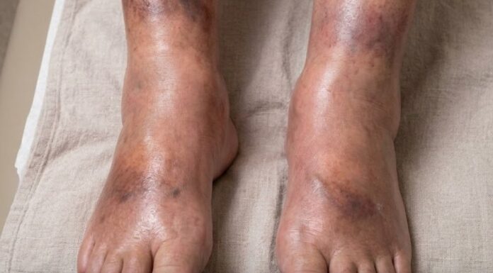 The silent signal: What your swollen legs may reveal about pancreatic cancer