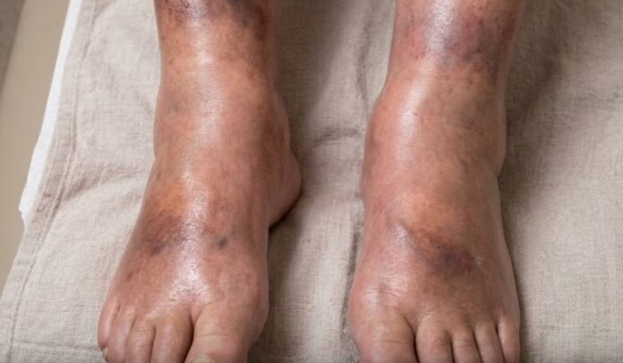 The silent signal: What your swollen legs may reveal about pancreatic cancer