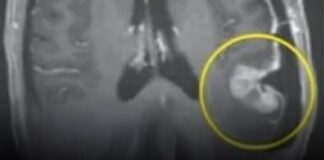 Woman’s inoperable tumor shrinks within five days following breakthrough cancer treatment