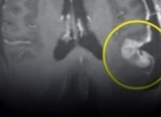 Woman’s inoperable tumor shrinks within five days following breakthrough cancer treatment