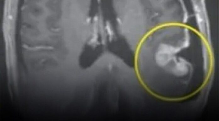 Woman’s inoperable tumor shrinks within five days following breakthrough cancer treatment