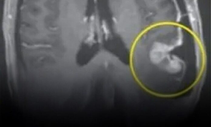 Woman’s inoperable tumor shrinks within five days following breakthrough cancer treatment