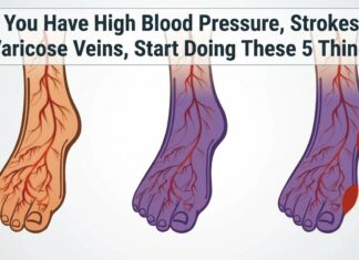 If you suffer from varicose veins start doing these five things