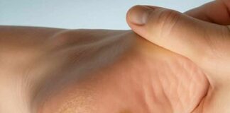 Plantar warts on the feet: what they are and why they shouldn’t be mistaken for a regular callus
