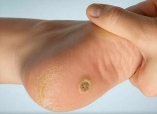 Plantar warts on the feet: what they are and why they shouldn’t be mistaken for a regular callus