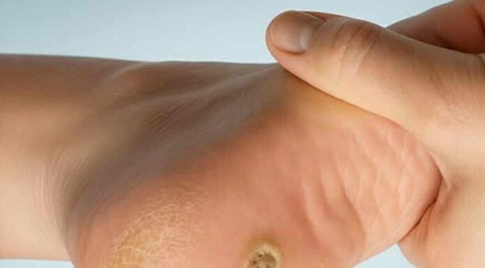 Plantar warts on the feet: what they are and why they shouldn’t be mistaken for a regular callus