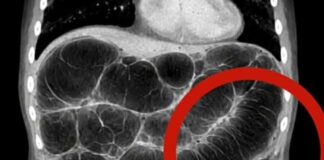 Frequent intestinal gas: the real causes that almost no one explains clearly