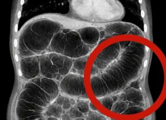 Frequent intestinal gas: the real causes that almost no one explains clearly