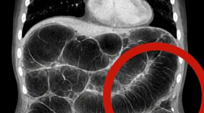 Frequent intestinal gas: the real causes that almost no one explains clearly