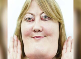 The incredible story of Victoria Wright: She inspires millions with her rare genetic condition