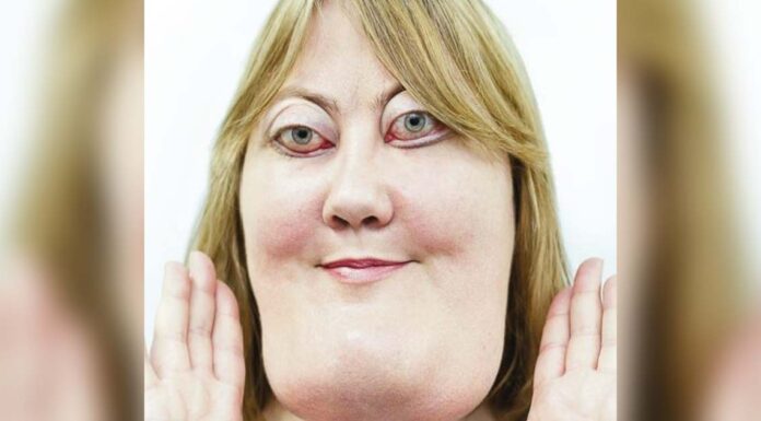 The incredible story of Victoria Wright: She inspires millions with her rare genetic condition