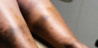 From itching to ulcers: understanding stasis dermatitis and what it reveals about your circulation