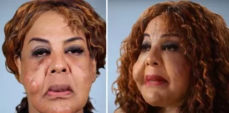 Rajee Narinesingh had her face pumped with cement and superglue– this is her today