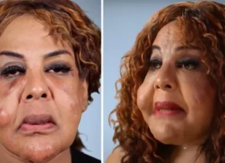 Rajee Narinesingh had her face pumped with cement and superglue– this is her today