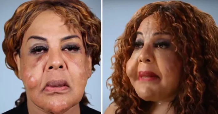 Rajee Narinesingh had her face pumped with cement and superglue– this is her today