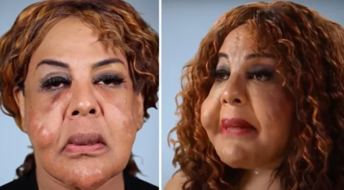 Rajee Narinesingh had her face pumped with cement and superglue– this is her today