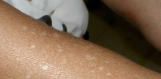 The mystery of the pale patch: A deep dive into small white spots on your skin
