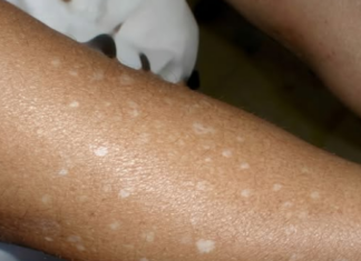 The mystery of the pale patch: A deep dive into small white spots on your skin