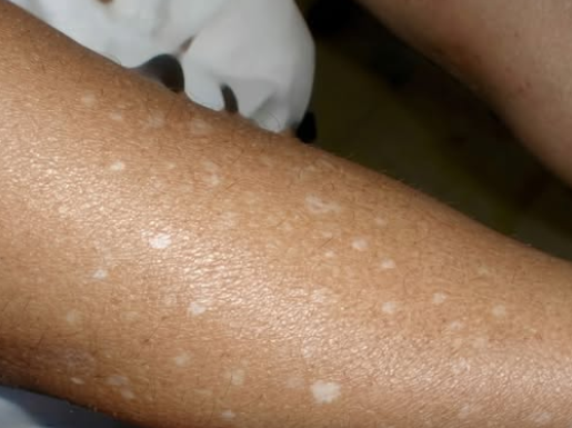 The mystery of the pale patch: A deep dive into small white spots on your skin