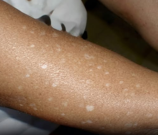 The mystery of the pale patch: A deep dive into small white spots on your skin