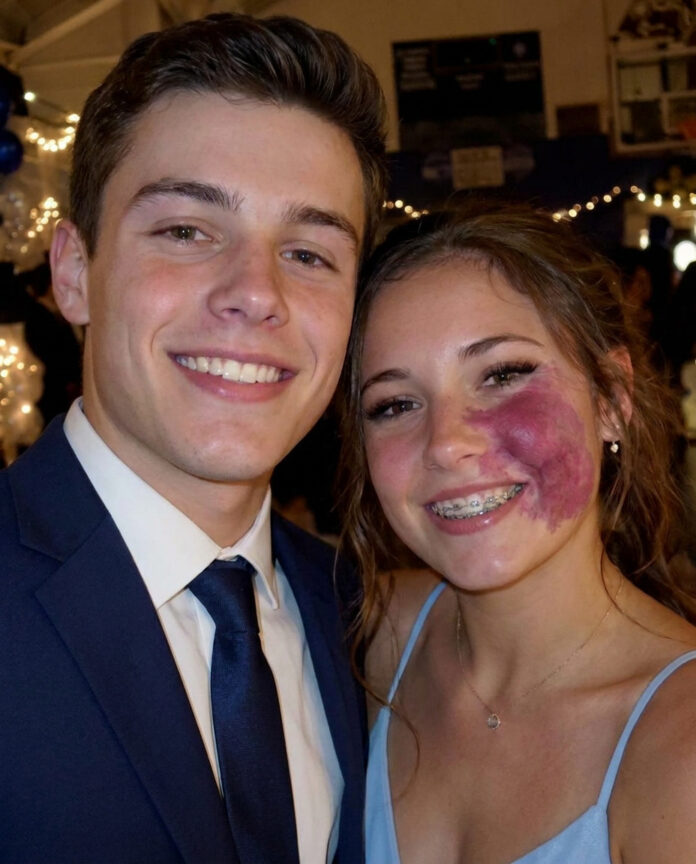 I was the only girl without a prom date because of my birthmark until one boy asked me — then police officers walked into the gym